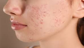 Tretinoin cho mụn trứng cá: Cách sử dụng, công dụng, hiệu quả và tác dụng phụ