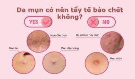 Có nên tẩy tế bào chết cho da mụn không và các lưu ý khi thực hiện